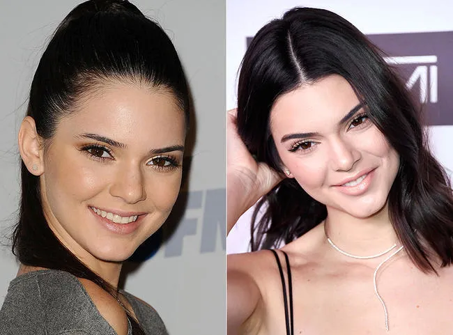 Aleyna Tilki yüzüne ne yaptırdı?-8