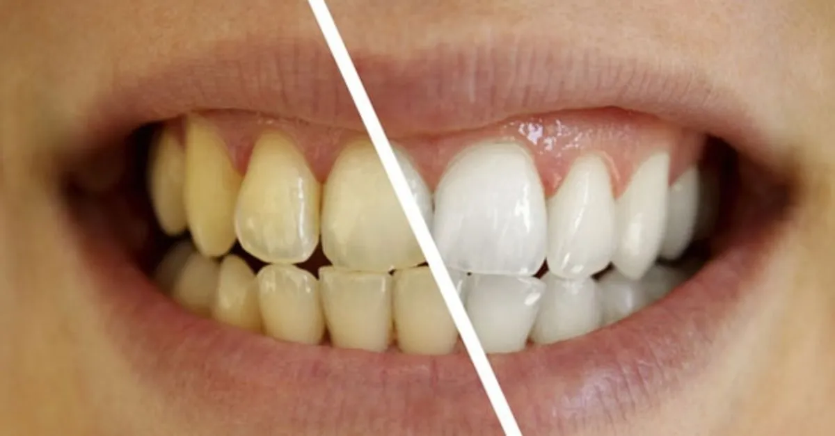 bu yontemle siz de bembeyaz dislere