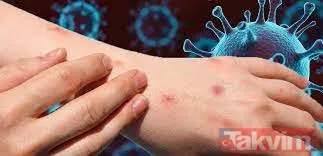 Maymun çiçeği nedir? Belirtileri neler? Çiçek aşısı Maymun çiçeğinden korur mu? Türkiye’de vaka görüldü mü? Sağlık Bakanlığı açıkladı - 8