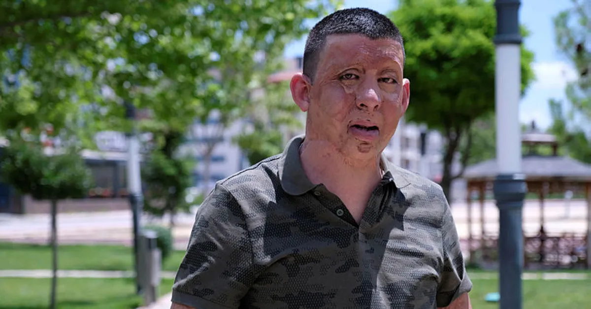 Vücudunun büyük bir bölümü yanan Gökhan Baran'ın hayatı, Başkan Erdoğan'ın talimatıyla değişti