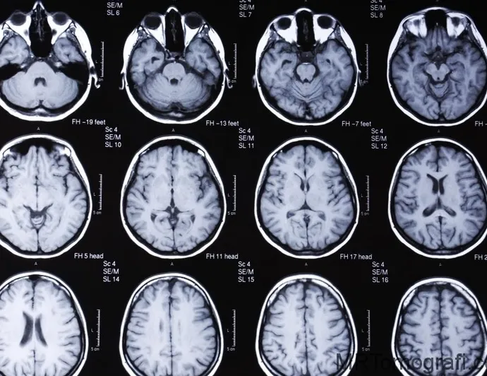 Çiğ et yedi tüm beynini tenyalar sardı