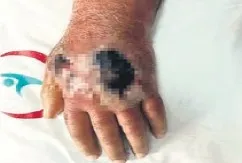 İnsan ısırığı kabus yaşattı