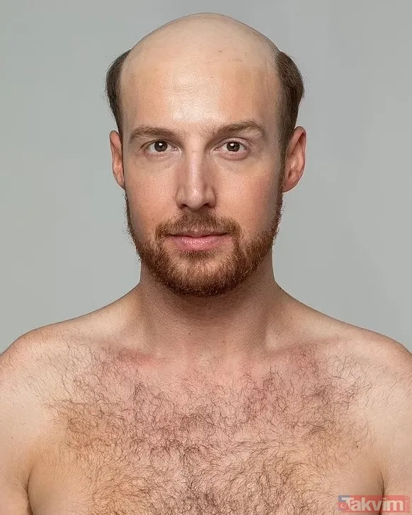 Durhamlı Johnny Thain'in Hikayesi, Saç Dökülmesinin Yalnızca Fiziksel Değil, Psikolojik Bir Travma Olduğunu Hatırlatıyor. Ancak Tiktok'ta Keşfettiği Devrim...