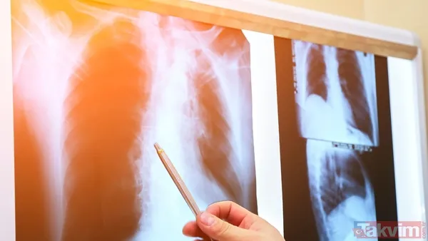 Akciğer Kanseri Belirtileri Neler? ◼ Akciğer Kanseri, Farklı Belirtilerle Kendini Gösterebilir Ve Hastalığın İlerleme Sürecine Bağlı Olarak Semptomlar...