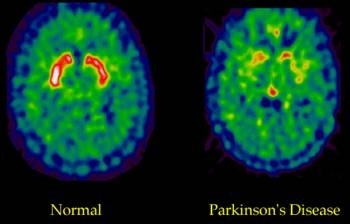 Parkinson hastası ünlüler...
