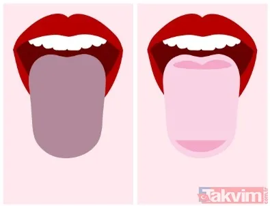 ⚪ Beyaz Lekeler (Lezyonlar) Krem Renkli Lezyonlar Genellikle Oral Pamukçuk Gibi Mantar Enfeksiyonlarına İşaret Ediyor. Ağız İçinde Yayılabilir Ve Yeme İçmede...