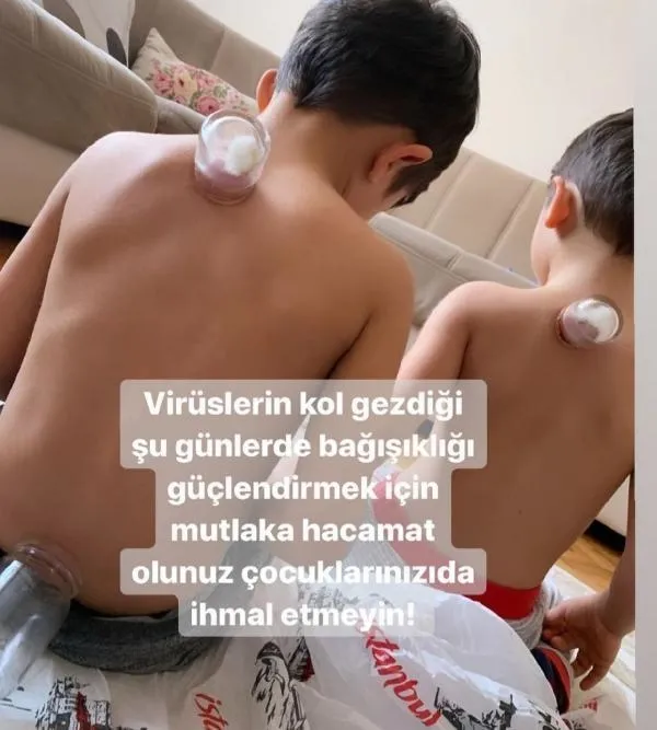 Sosyal medyadaki hacamat görüntüleri olay yarattı: Bebeklere bile yaptılar! Uzmanlardan kritik uyarı-6
