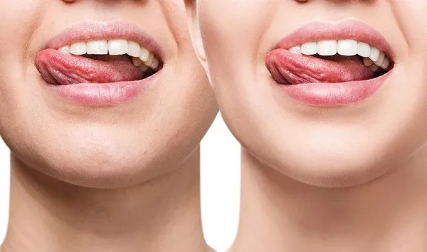 Dildeki beyazlık hastalık habercisi olabilir-14