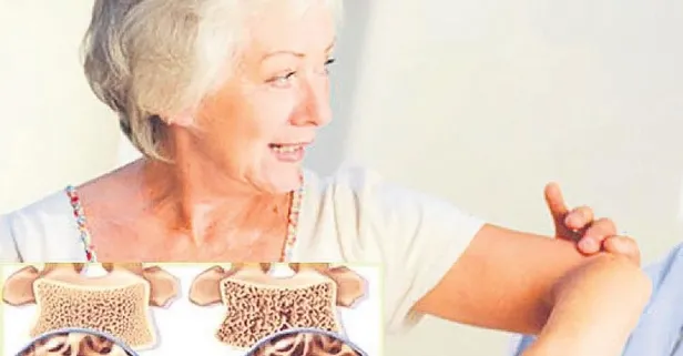 Kemik erimesi kadın düşmanı! Osteoporozdan korunmanın sırrı...