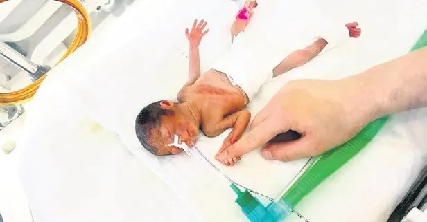 Samsun’da mucize bebek Aylin!