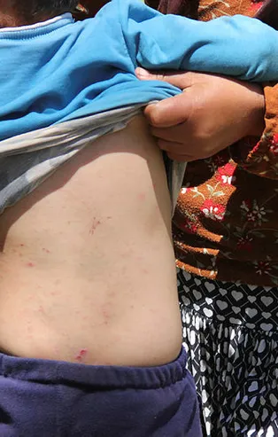 Sivas'ta ormanlık alanları istila eden tırtıllar yüzünden günde 10 kişi hastaneye gidiyor!