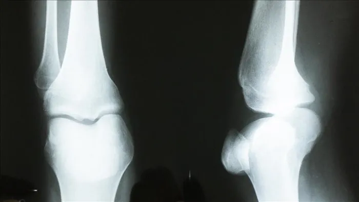 Süt değil sebze tüketin: Uzmanı, osteoporozla ilgili önemli bilgileri TAKVİM'e anlatıyor-2