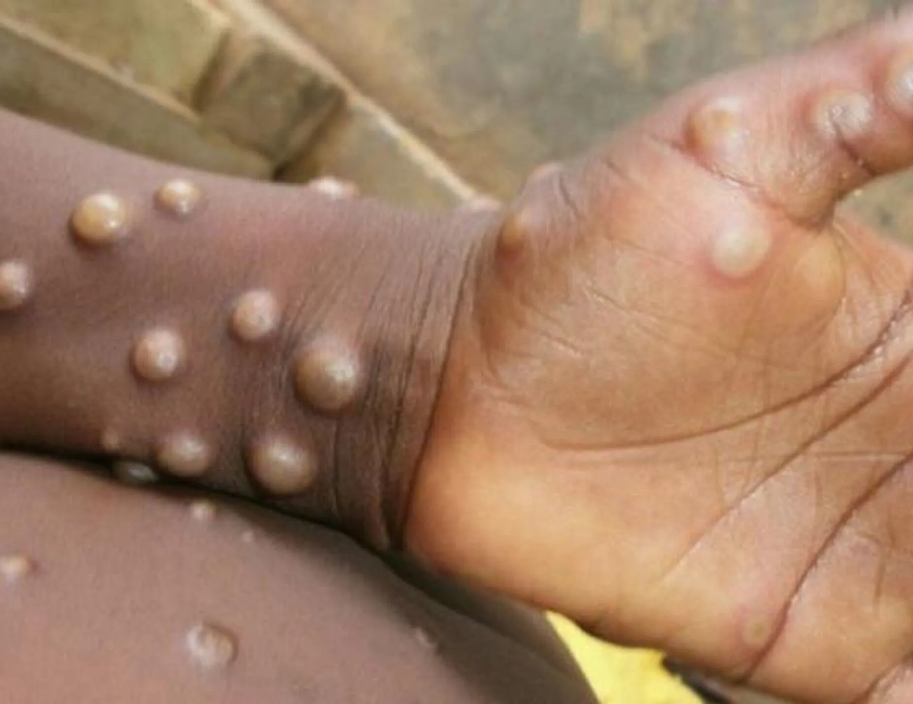 Türkiye’de maymun çiçeği vakası görüldü mü?