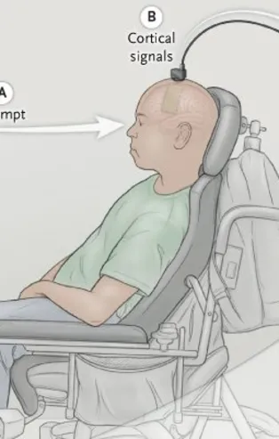 Felç geçiren hastayı beyin dalgalarını deşifre ederek konuşturdular