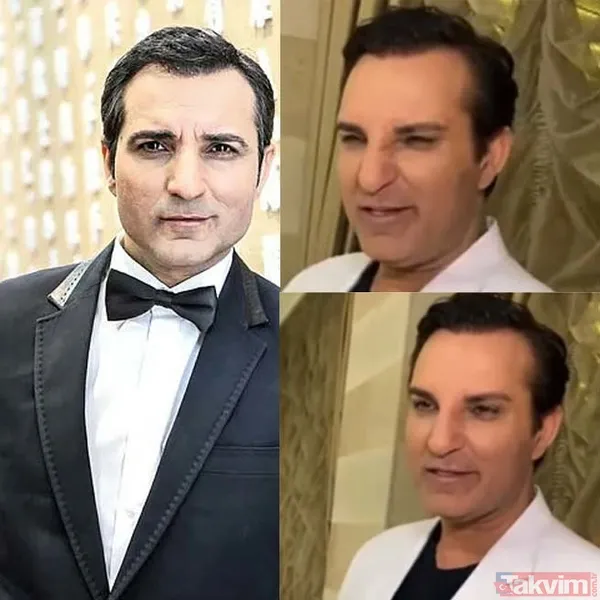 Alişan'dan botoks itirafı! İşte estetik yaptıran erkek ünlüler - 4