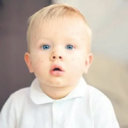 Çocukların yüzde 10’unda besin alerjisine sahip!