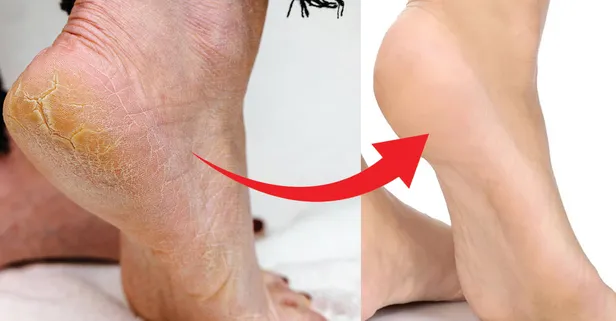 Akşam sür sabaha pamuk gibi olsun! Topuk çatlaklarını, ayak nasırlarını ve mantarlarını 2 malzemeyle yok et!