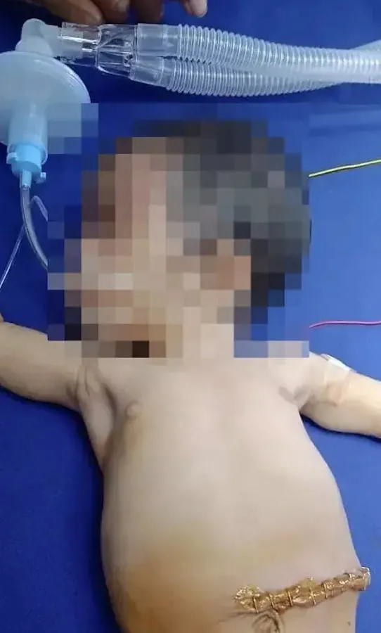 Bilim insanları dahi şaşkın! Yenidoğan bebeğin karnındaki şişliğin içinden çıkanlar kan dondurdu! Tümor sandılar ama tam 8 tane...-9