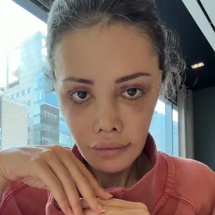 Yüz nakli yaptıran Didem Ceran hastalığını ilk kez açıkladı: Saklamak istemiyorum