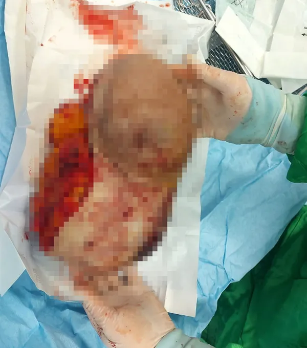 doktora-gitti-memesinden-45-kiloluk-kitle-cikarildi-1613978383884.jpg Doktora gitti! Memesinden 4,5 kiloluk kitle çıkarıldı-3