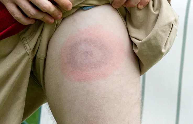Lyme hastalığı nedir? AIDS'ten bile tehlikeli olan lyme hastalığı bulaşıcı mıdır? Lyme hastalığı tedavi edilebilir mi?  - 10