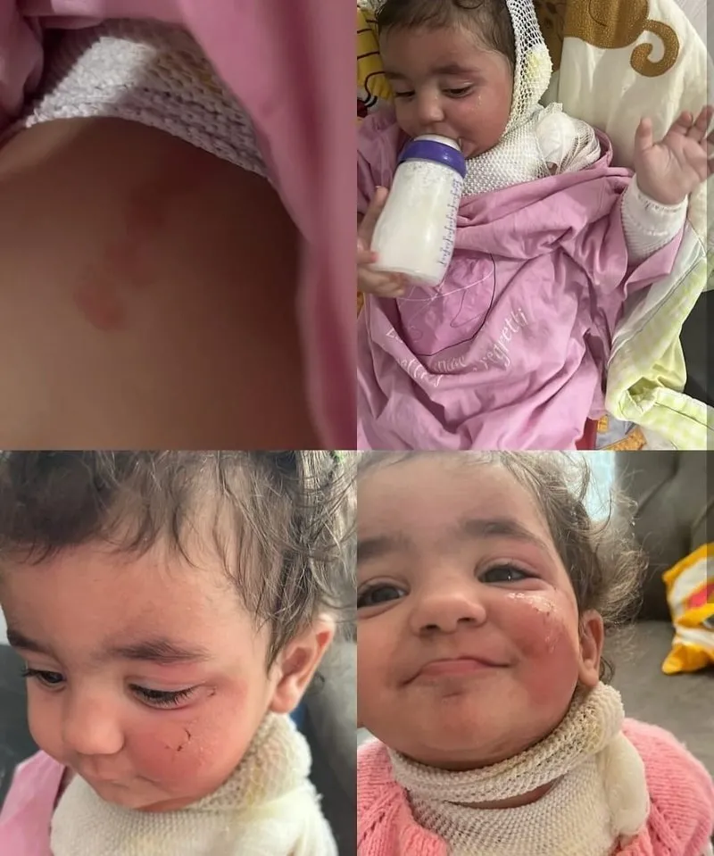 Aden bebeğin vücudunda 2'nci derece yanıklar meydana geldi (İHA)