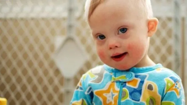 Down Sendromu Nedir Neden Olur Tedavisi Var Mi Down Sendromu Kromozom Farki Nasil Anlasilir Takvim