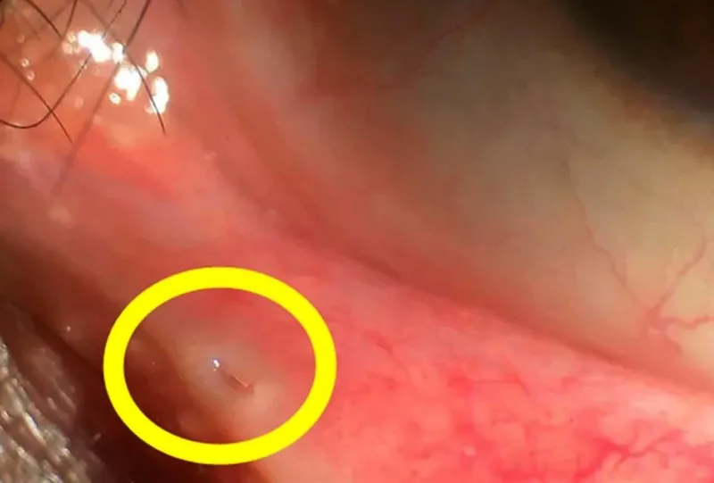 goz-kapaginin-ic-kismindaki-bu-delik-bakin-ne-ise-yariyor-1710336022170.jpg Göz kapağının sağ sol iç kısımlarındaki bu delik bakın ne işe yarıyormuş-2