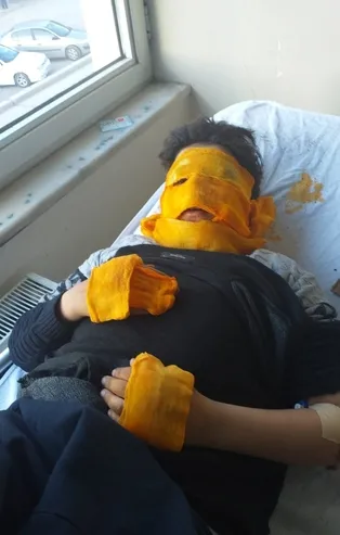 Erzurum'da ateşle oyun feci bitti! Yüzü tamamen yandı