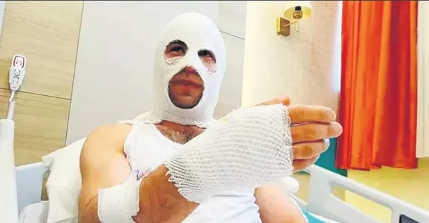 Erzurum’da sprey boya faciası: Vücudu yanık içinde kaldı!