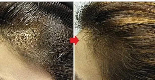 Bu yöntemle tutam tutam saç fışkıracak: 2 ayda 6 cm uzatıyor! Genetik kelliğe biberiye yağı çözümü!