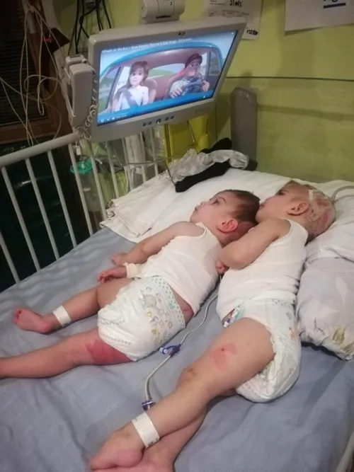 Başkan Erdoğan güzel haberi duyurmuştu! Antalyalı siyam ikizleri Derman ve Yiğit Evrensel'den yeni fotoğraf-3