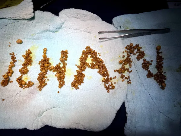 zonguldakta-47-yasindaki-kadin-hastanin-safra-kesesinden-1250-tane-tas-cikti-doktor-taslarla-kendi-adini-yazdi-1652767041562.jpg Zonguldak'ta 47 yaşındaki kadın hastanın safra kesesinden 1250 tane taş çıktı! Doktor taşlarla kendi adını yazdı-8