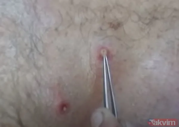 Karnındaki şişlik için gitti içinden çıkan doktorları bile şoke etti! Yer uzak değil Kayseri! 64 kilo girdi 55 kilo çıktı - 28