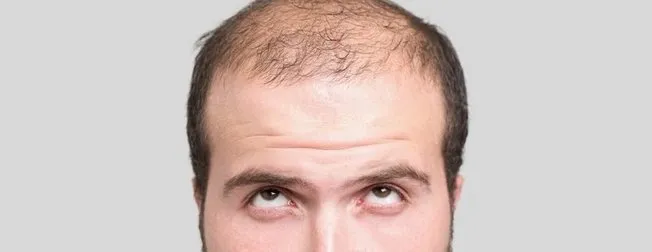 sac dokulmesine ne iyi gelir sac dokulmesi nasil gecer evde dogal tedavi yontemler takvim