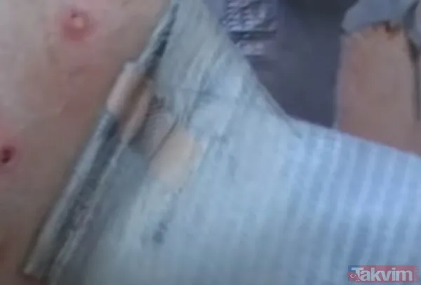 Karnındaki şişlik için gitti içinden çıkan doktorları bile şoke etti! Yer uzak değil Kayseri! 64 kilo girdi 55 kilo çıktı - 18