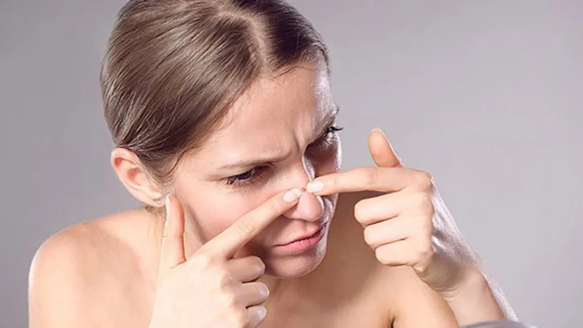 Her 5 kadından birinin yaptığı akneye yol açan 7 hatalı alışkanlık