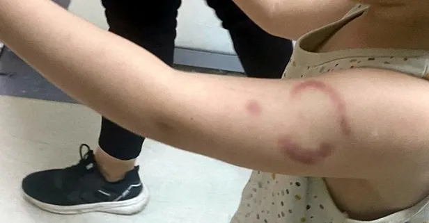 Kreşte öğrencisinin kolunu ısırdı! "Severken oldu" bahanesi tutmadı: O öğretmen tutuklandı