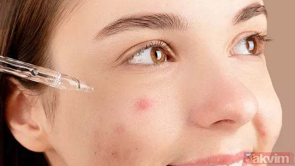 ↪ Topikal Akne Tedavilerinin Yan Etkileri Arasında Geçici Kuruluk Ve Kaşıntılı Döküntüler Bulunurken, Ağız Yoluyla Alınan İlaçlar İse Mide Bulantısı, Baş...