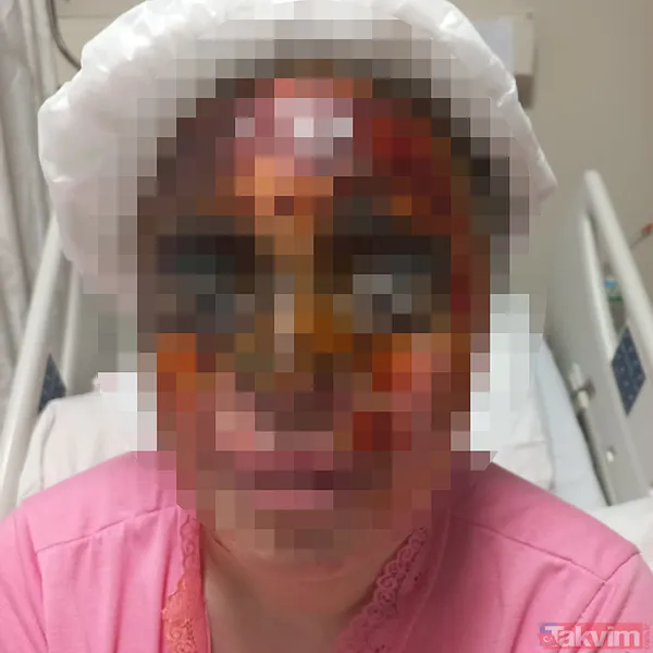 Yolda yürüyen kadının yüzüne kezzap döktü! Avcılar'da korkunç olay - 5