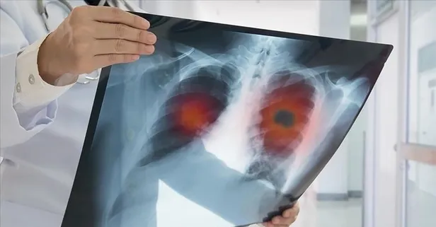 Uzmanı akciğer kanseri hakkında bilinmesi gerekenleri açıkladı!