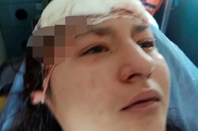 2. Asiye Ateş vakası! Kastamonu'da sokak köpekleri selfie yapan genç kızın yüzünü parçaladı