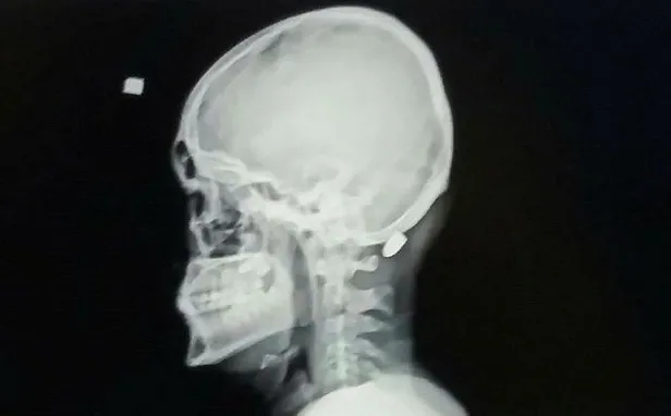 1 cm ile felç olmaktan kurtulan 18 yaşındaki genç: İlk başta çekiçle vurdular sandım-3