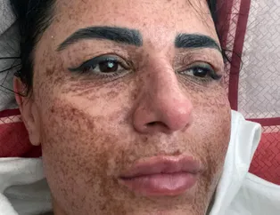 Yüzü yanan kadının muhteşem dönüşümü