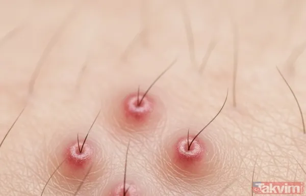 Prof. Saraçoğlu’ndan Kıl Kökü İltihabına Kesin Çözüm - 2