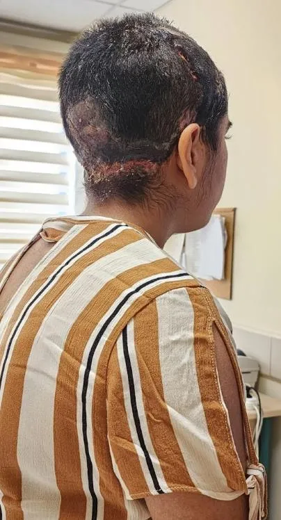 antalyada-go-kart-faciasi-saci-tekerlege-dolaninca-kafa-derisi-yerinden-siyrildi-1694360045398.jpeg Antalya'da Go-kart faciası! Saçı tekerleğe dolanınca kafa derisi yerinden sıyrıldı: Genç kız ölümden döndü-4