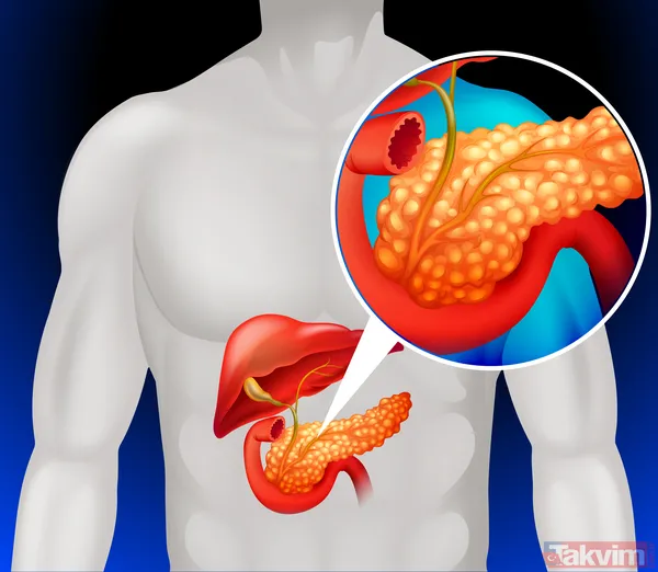 Reflü sandığı belirtiler pankreas kanseri çıktı: Teşhisten altı hafta sonra veda etti - 2