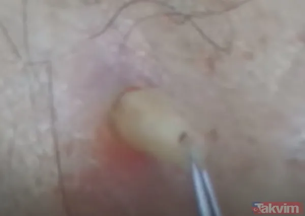 Karnındaki şişlik için gitti içinden çıkan doktorları bile şoke etti! Yer uzak değil Kayseri! 64 kilo girdi 55 kilo çıktı - 38