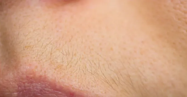 Kalıcı olarak bitecek! Yüzdeki şeftali tüylerinin kökünü kurutacak şeker ve limon kürü