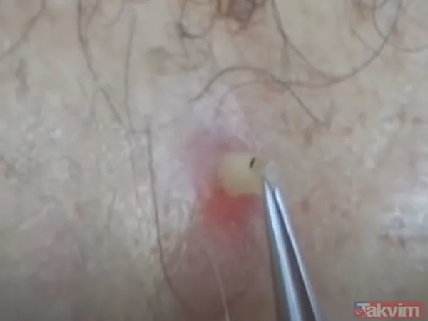 Karnındaki şişlik için gitti içinden çıkan doktorları bile şoke etti! Yer uzak değil Kayseri! 64 kilo girdi 55 kilo çıktı - 34